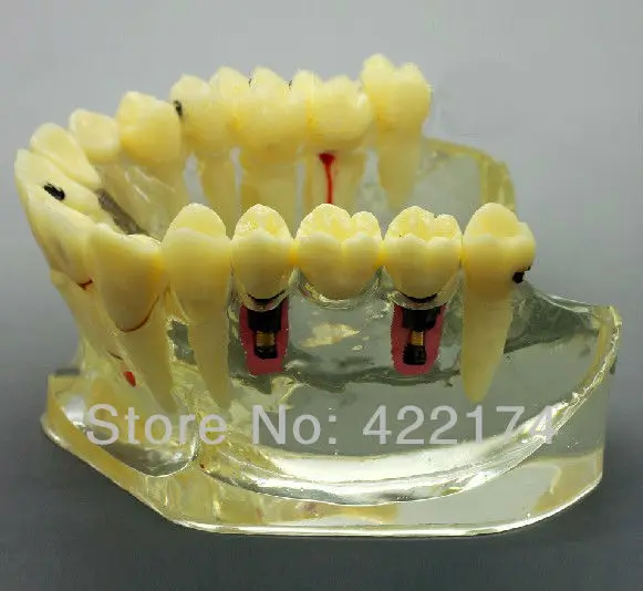 Стоматологическая лупа восстановление протез исследование модель зубной зуб зубы стоматолог стоматология анатомическая модель