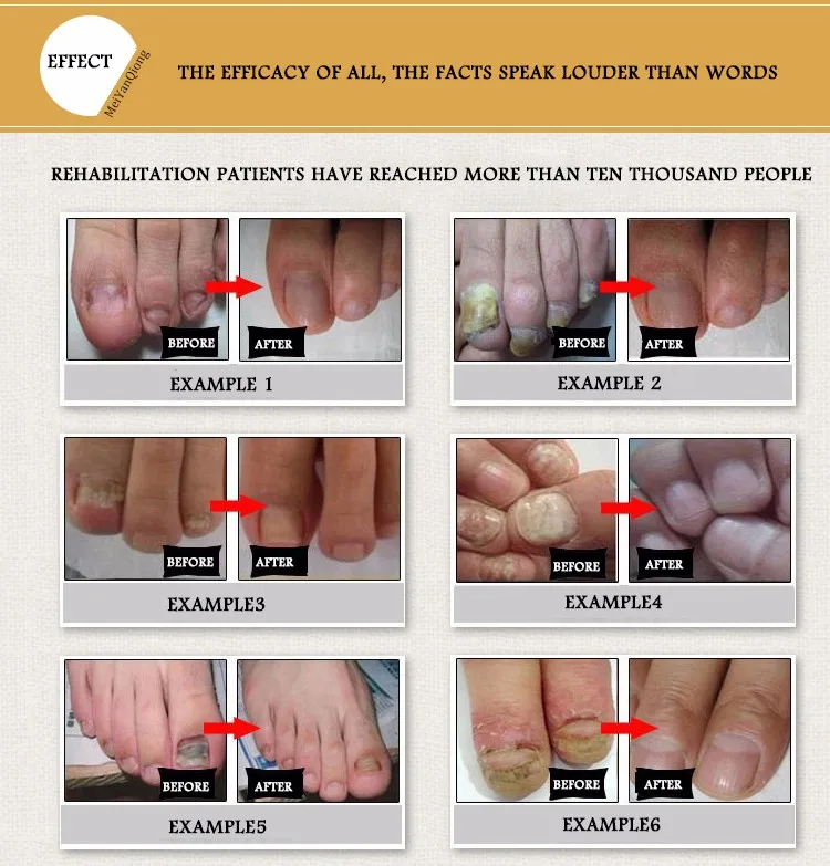 Meiyanqiong средства для ухода за ногтями противогрибковые Уход за ногтями эссенция для ногтей Удаление грибка гель анти-инфекция паранихия онихомикоз