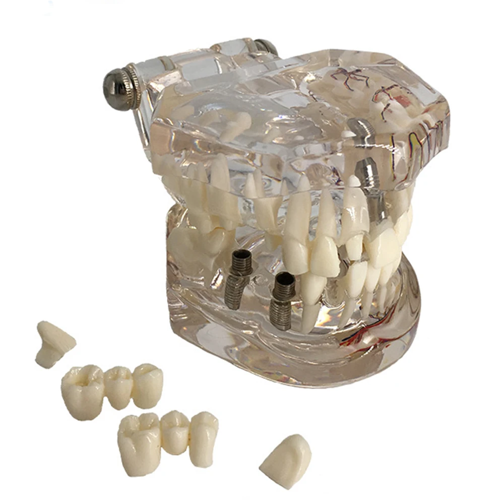 Стоматологическая модель зубов прозрачное исследование патологический имплантат человеческие взрослые зубы нерва модель низкая цена