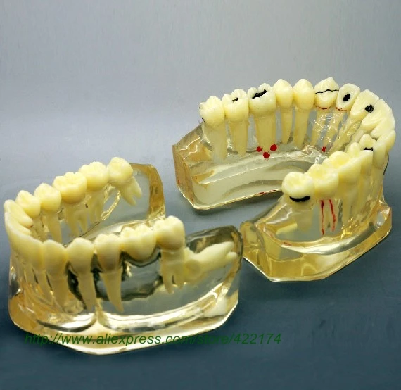 2 раза взрослых патологий модель зубной зуб зубы анатомические Анатомия Стоматологическая модель