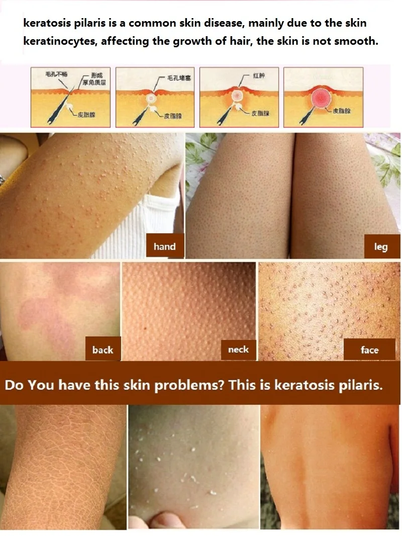keratosis pilaris exfoliation