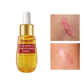 

New 20ml Skin Scar Acne Mark Removal Essence Face Body Acne Postpartum Scar Repair Cream Skin Care Tool
