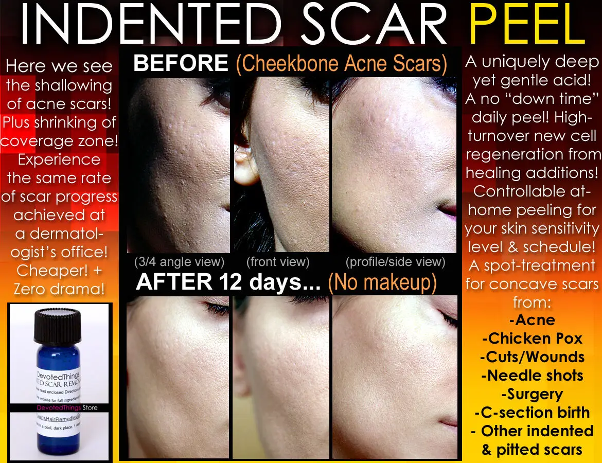 

Indented Acne Scar Removal Peel Chicken Pox Ice pick Rolling Boxcar Scars