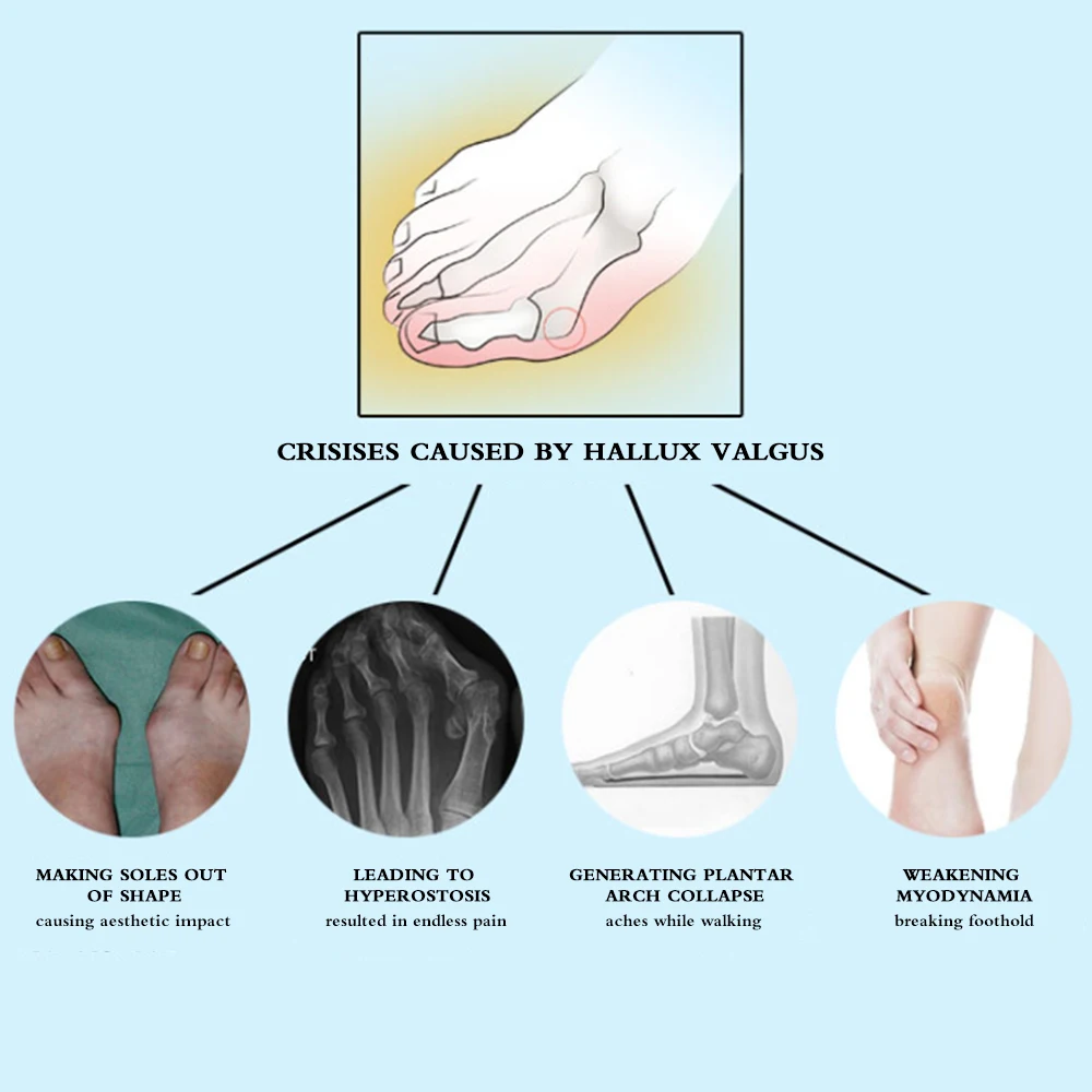 1 шт. Регулируемый корректор большого пальца стопы, шина для коррекции стоп, вальгусная деформация, выпрямитель, облегчение боли, ортопедический инструмент для ухода за ногами