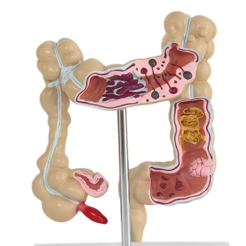 Колоректального модель поражения человека толстой кишки для стоматологов патологическая заболеваний модель медицинский Органайзер анатомия
