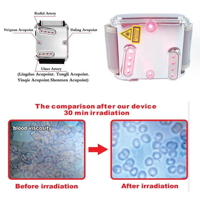 Weber Medical Device Laser Watch Treatment Tinnitus Laser Therapeutic Acupuncture Watch Laser Therapy Diabetes Otitis Media Weber Medical Device Laser Watch Treatment Tinnitus Laser Therapeutic Acupuncture Watch Laser Therapy Diabetes Otitis Media