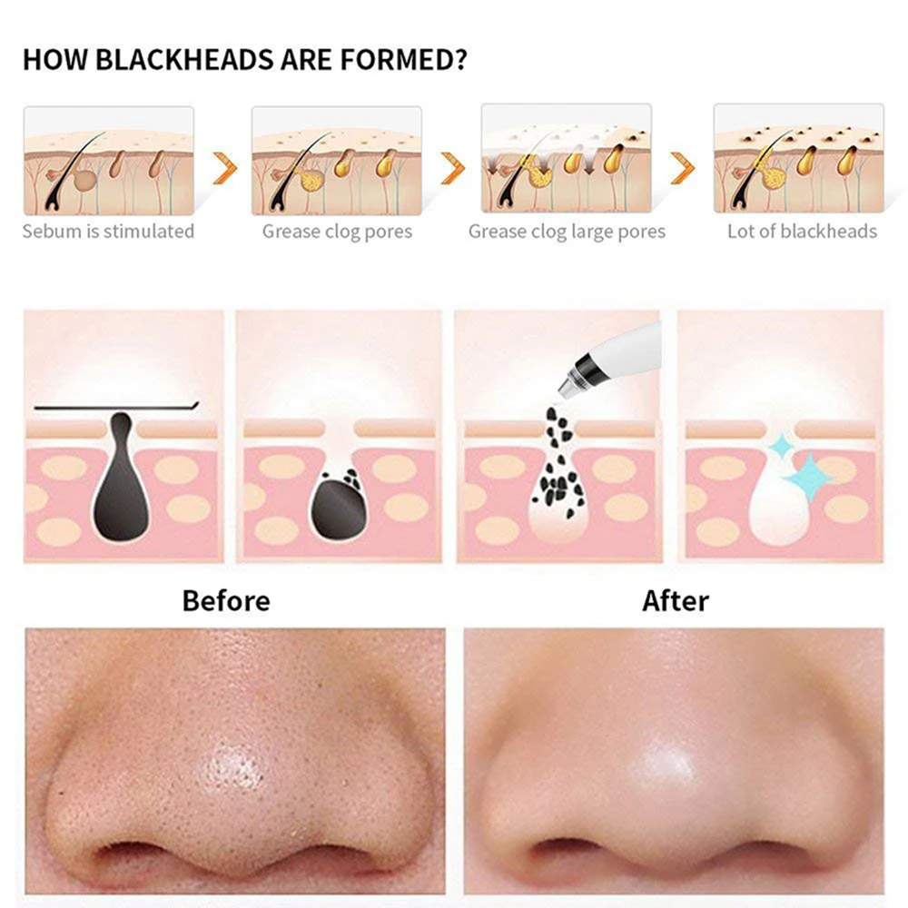 Blackhead-Remover (5)