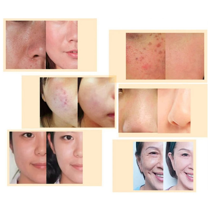 DARSONVAL DRS 6 in 1 micro needles derma roller titanium mezoroller microneedle machine for skin care and body treatment
