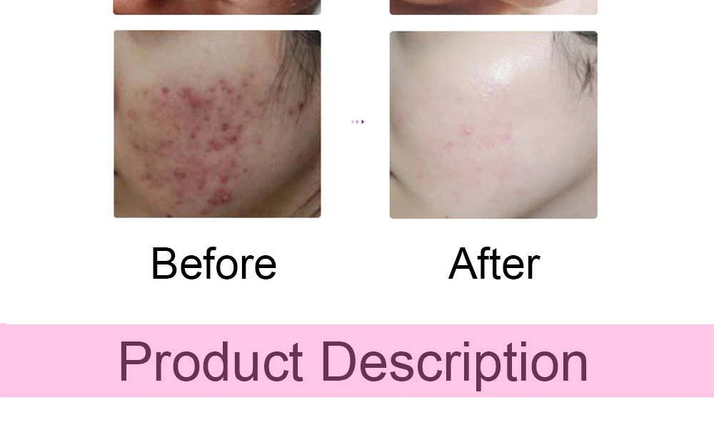 black head removal moisturising machine (8)