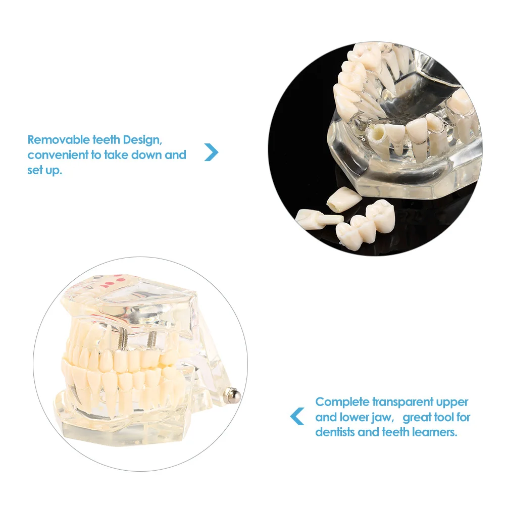 Прозрачная модель зубов нижняя челюсть Модель Стоматологическая имплантация инфекция съемные Обучающие инструменты для зубов стоматологическая медицинская наука