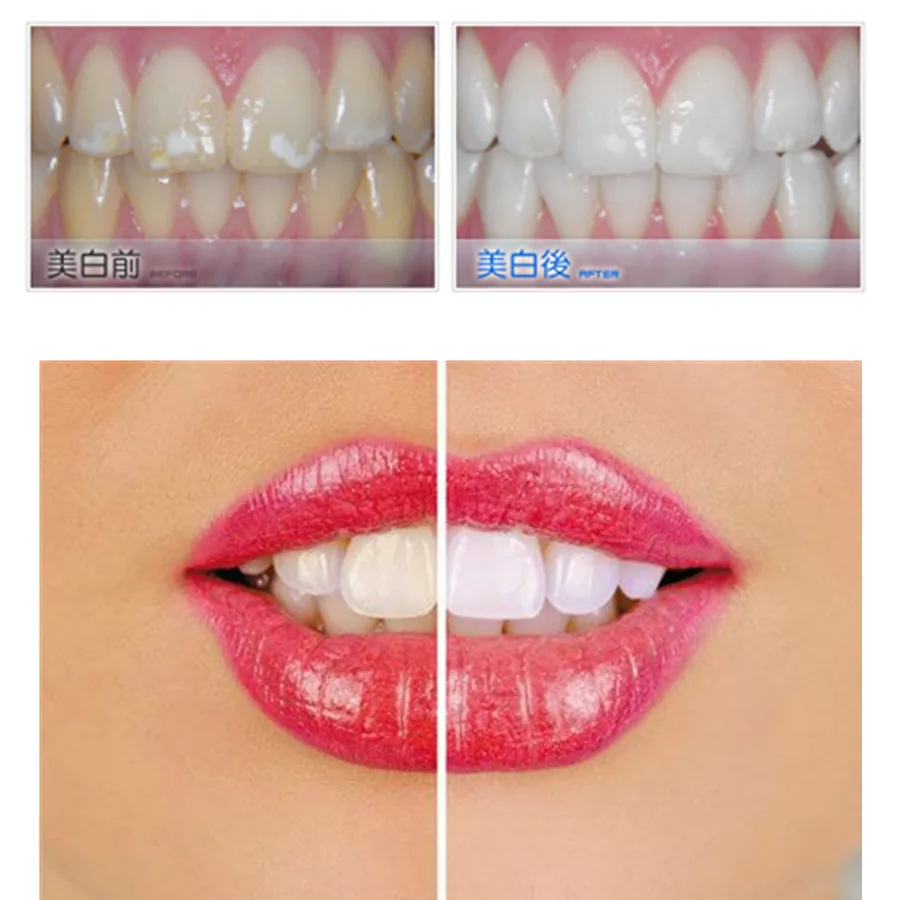 Стоматологического оборудования стандарт FDA зубы, отбеливание зубов 44% отбеливание перекисью Системы гигиена полости рта гель комплект для дыма зубы