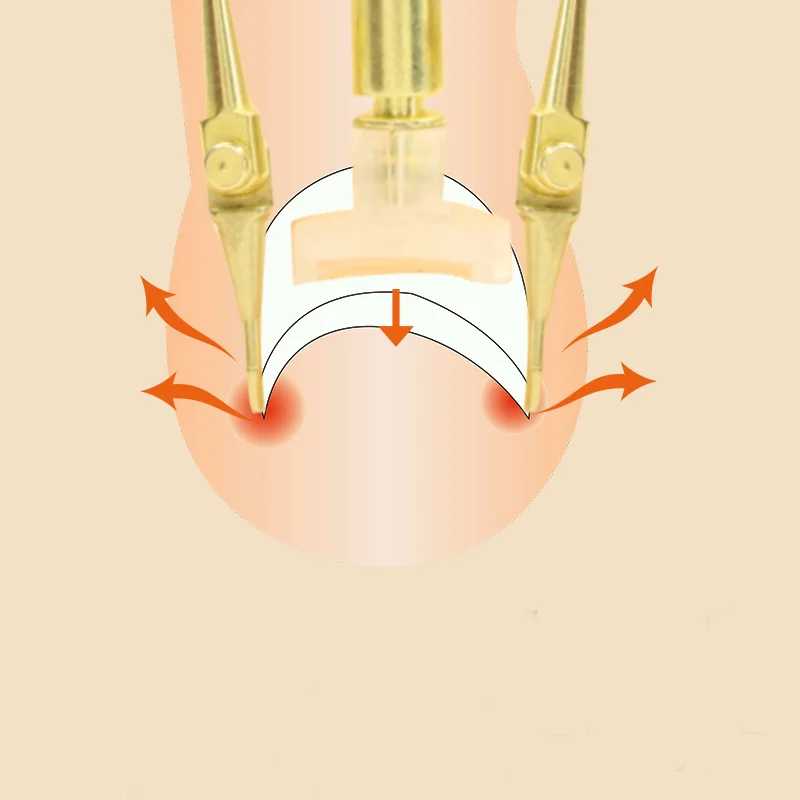 2 в 1 вросших носком коррекция ногтей фиксирующий инструмент для 1 или 2 стороны для вросших ногтей, педикюра инструмент для маникюра Файл Нипер