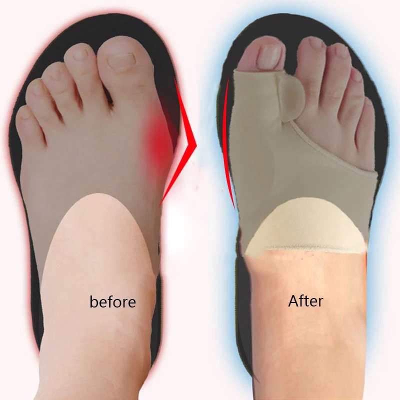 Putimi 2 шт корректор вальгусной деформации для пальцев ног сепаратор пальцев ног профессиональные силиконовые ортопедические инструменты большая кость пальца ноги без мозолей