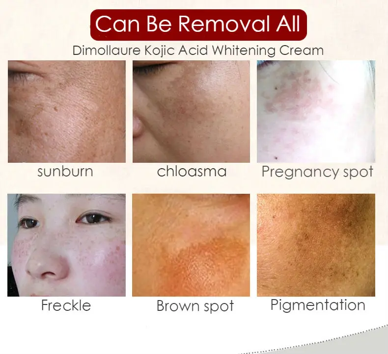 Dimollaure Kojic acid отбеливающий крем ретинол Витаминная сыворотка удаление веснушек