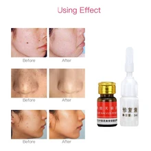 Раствор для удаления кожных ярлыков от Крота, для удаления темных пятен, для лица, для бородавки, веснушек, для ухода за кожей, для восстановления пятен, горячая распродажа