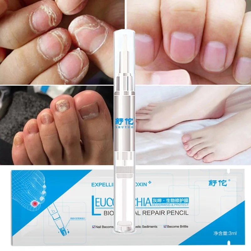 Ручка для ногтей Onychomycosis Paronychia инфекция травяные ногти для пальцев ног Здоровье Красота аксессуары TSLM1