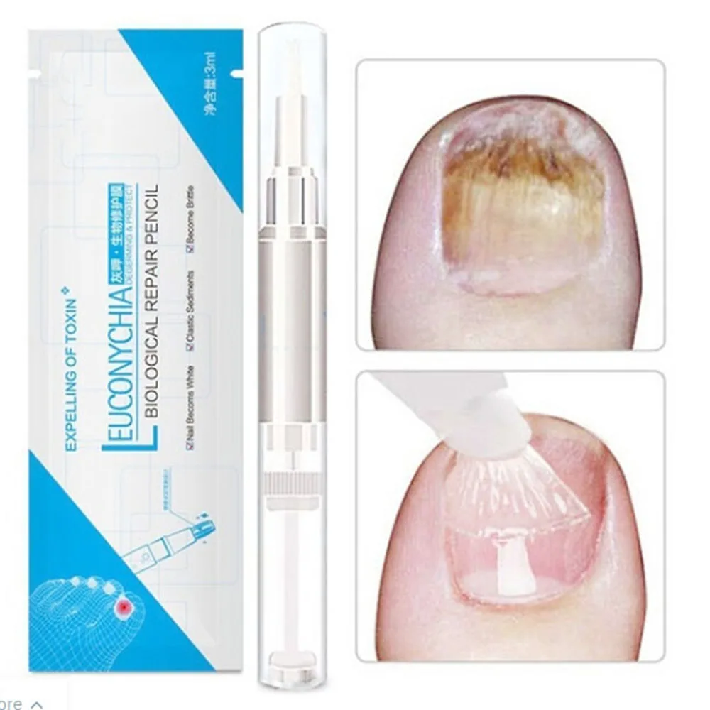 

Nail Fungal Treatment Pen Anti Fungus Infection Solution Nutritious Oil 3ml Herbal Restores Toe Finger Nails Health Beauty