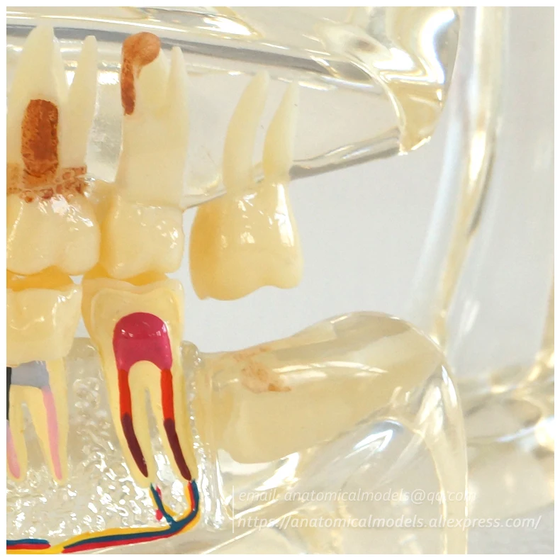 13066 Half Pathology Model 