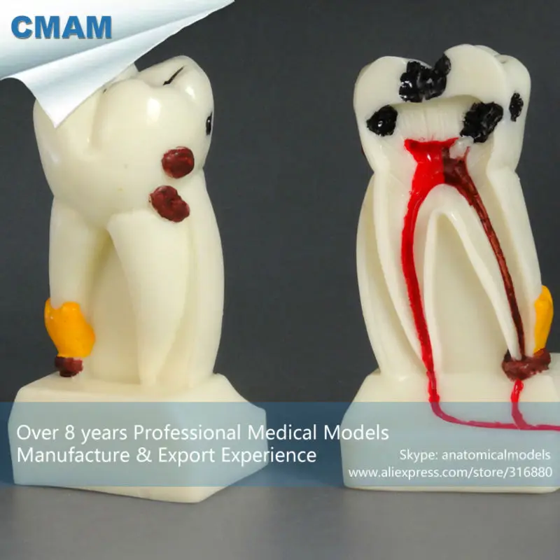 

CMAM-DT4P02 Human Dental Tooth 4x Size Pathological Study Anatomical Model