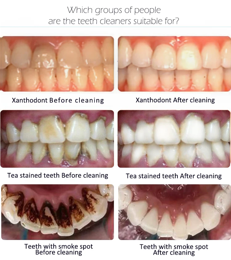 Limpador de Dentes Remover a Mancha Cabeças de Escova Elétrico Dental Tártaro Odor Oral 30-60s Dentes Branqueamento Esmalte Seguro 3 Modos 4 & 21 Cheap Escovas de dente elétricas