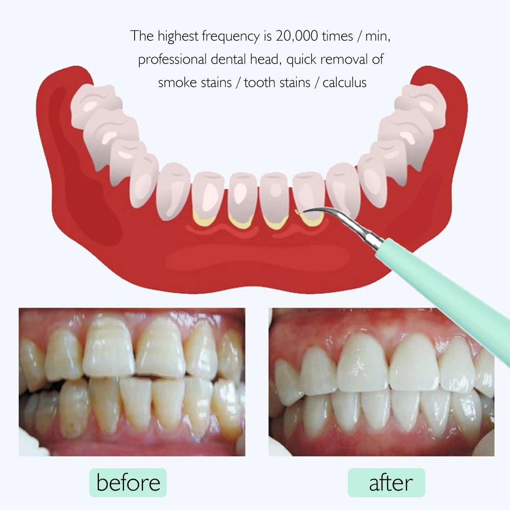 2 шт Сменные головки для чистки зубов, силиконовая звуковая электрическая Стоматологическая система для удаления зубных пятен