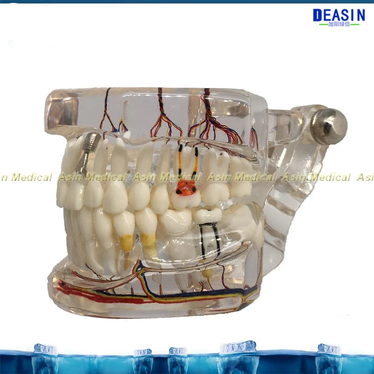 Новая модель зубного имплантата зубы с нервом прозрачная патологическая модель ремонта обучающая демонстрационная модель