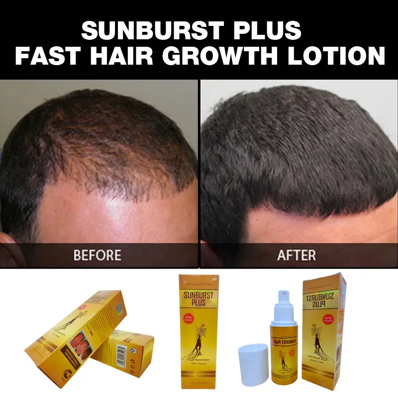 3 bottles Sunburst Plus Hair Growth Lotion NEW UPGRADE 100ml fast hair growth products anti hair