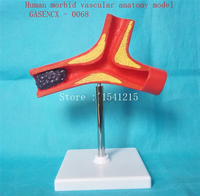 

Lesion vascular model Medical teaching model Vascular occlusion model Human morbid vascular anatomy model - GASENCX - 0068