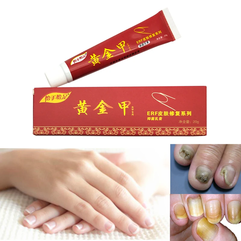 Aanbieding 2019 New Nail Fungus Treatment Ointment Toe Onychomycosis