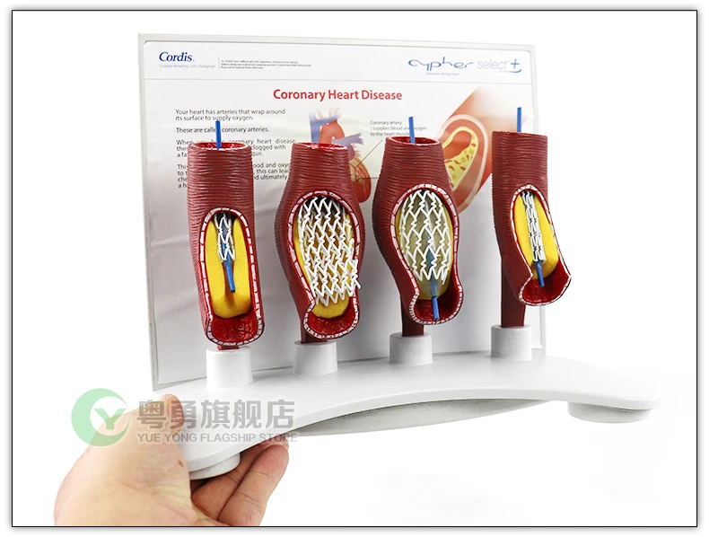 Изображения кровеносных сосудов Блокировка стент для увеличения модель сердца стент Ишемическая стент модель образовательное оборудование