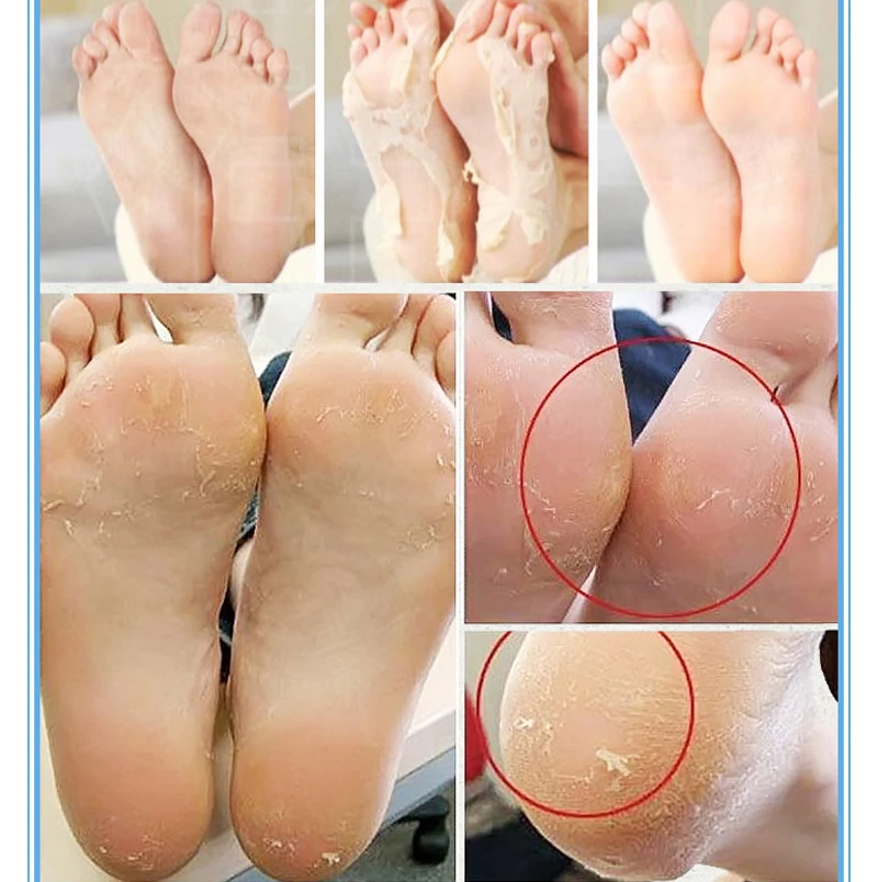 200pcs-moisture-spa-Callus-Bamboo-Vinegar-peeling-renewal-remove-dead-skin-Cuticles-Heel-smooth-exfoliating-foot