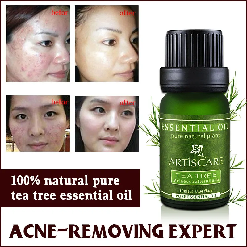 ARTISCARE 100% شجرة الشاي النقي زيت طبيعي الجلد حب الشباب زيت العلاج البثرة مزيل مكافحة ندبة البقع الوجه الجمال زيت التدليك ARTISCARE 100% شجرة الشاي النقي زيت طبيعي الجلد حب الشباب زيت العلاج البثرة مزيل مكافحة ندبة البقع الوجه الجمال زيت التدليك