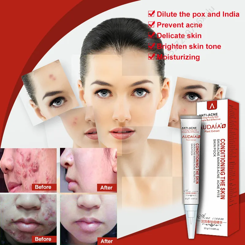 Facial Treatments Anti Aging Oil control Skin Care Acne Cream