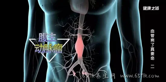 健康之路20190614,腹动脉瘤的形成,治疗方法,血管病了真要命2