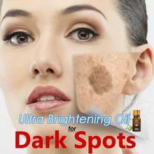 Ultra Brightening Spotless Oil Skin Care Dark Spots Remove Ance Burn Strentch Marks Scar Removal Brightening Skin Essence 10ml