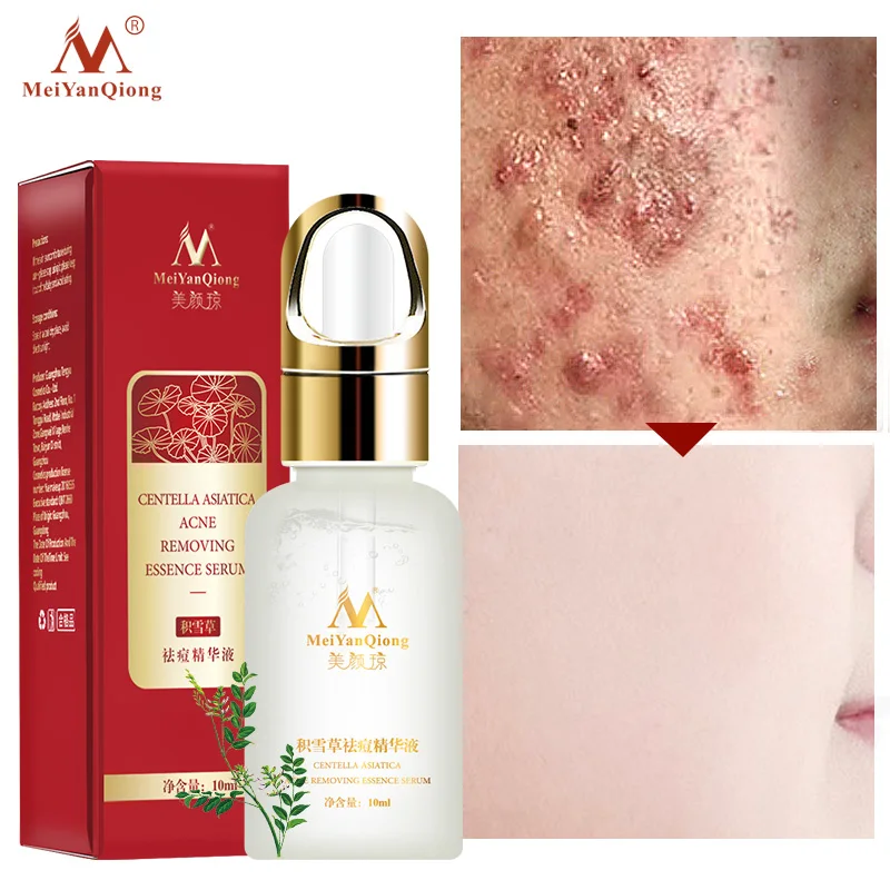 

Centella Asiatica Acne Removing Essence Improve Pox Muscle Smooth Skin QRD88