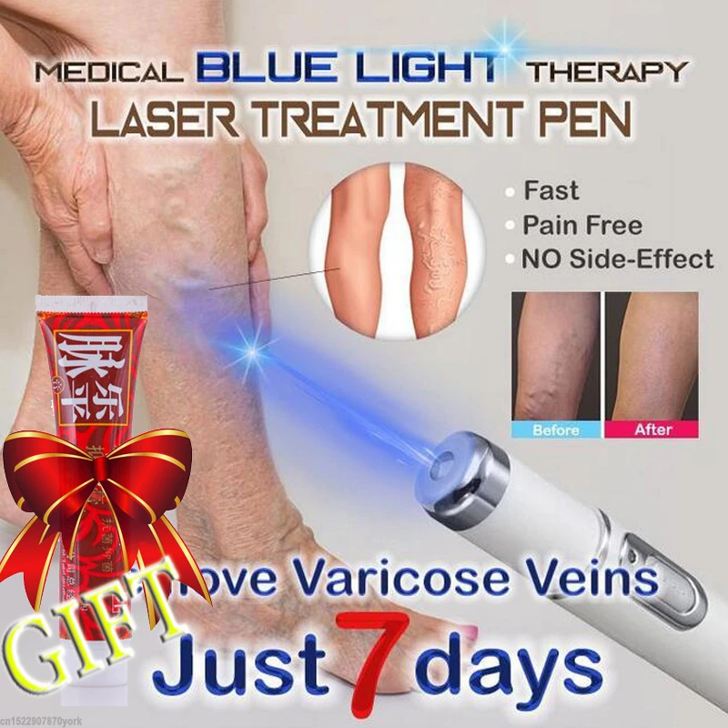 Tratament laser pentru varice
