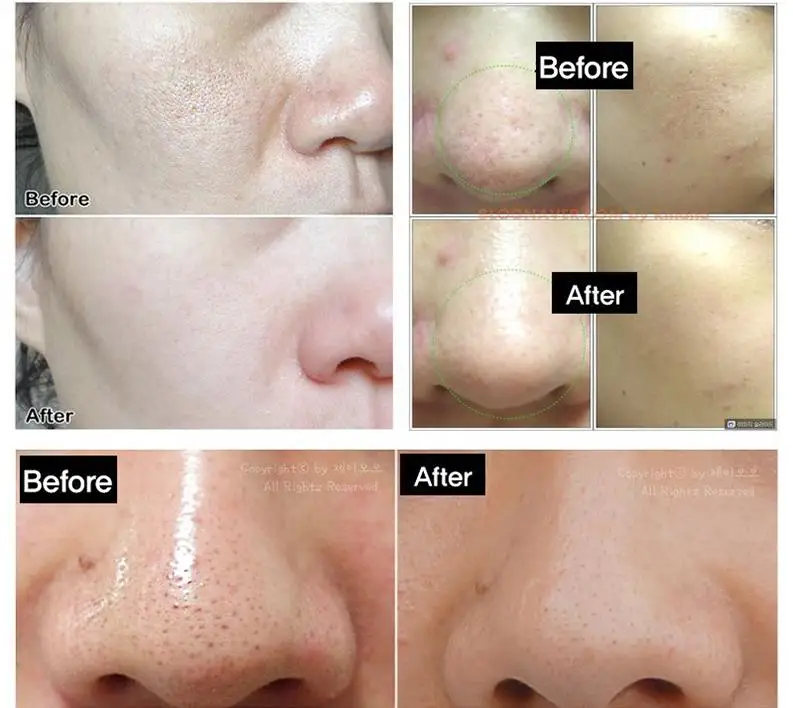TOSOWOONG Platinum Miracle Pore Tightening Pack 150 г маска для лица для удаления угрей глубокое очищение угрей, уход для очищения пор