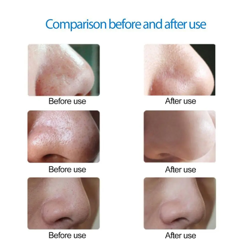 mancha cleaner sujeira sugar up acne espinha