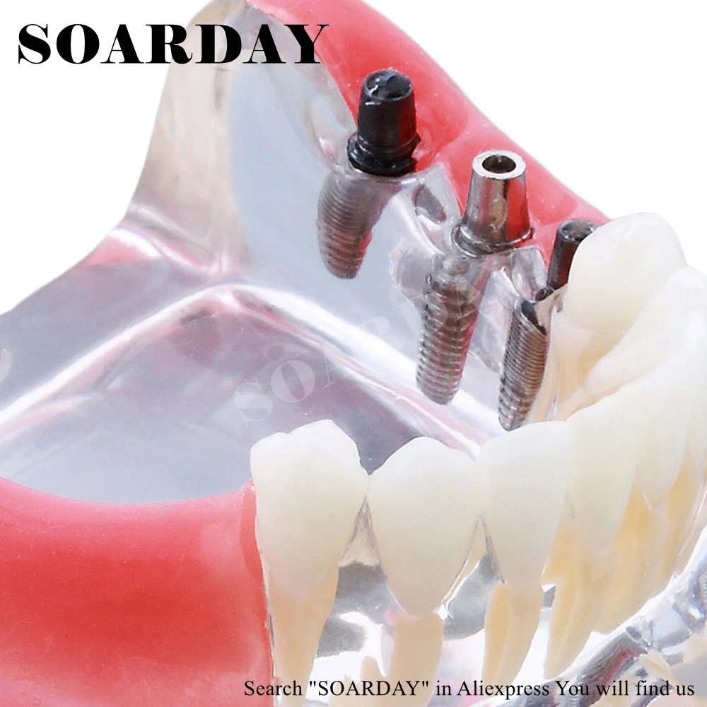 Implant & Restoration Model (3)