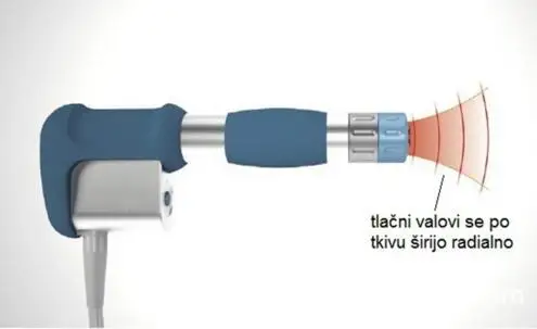 Экстракорпоральная шоковая волновая Терапия акустическая волна Shockwave терапия для облегчения боли при артрите экстракорпоральная