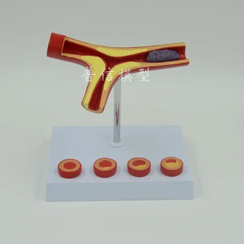 

Human Arterial Atherosclerosis Arteriosclerosis Mode with 4 Pieces Cross Section Thrombus Model Human Vascular Model 10X Large