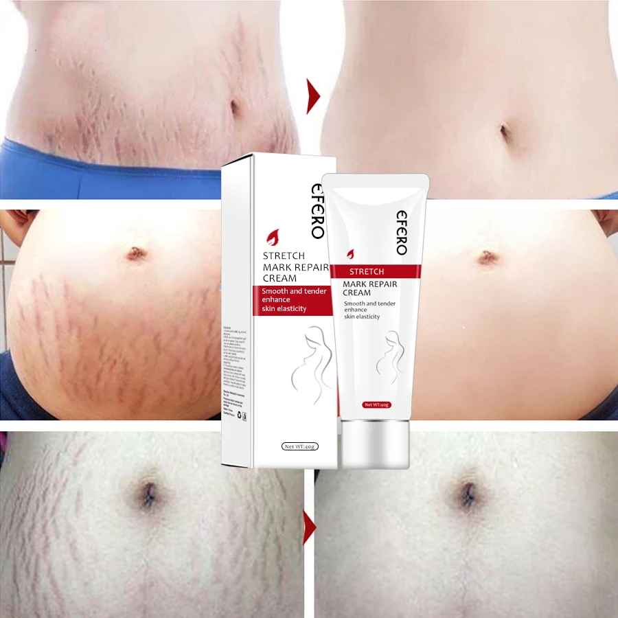 

40G EFERO Skin Care Pregnancy Stretch Marks Remover Cream Natural Body Maternity Scar Removal Cream for Stretch Marks Treatment