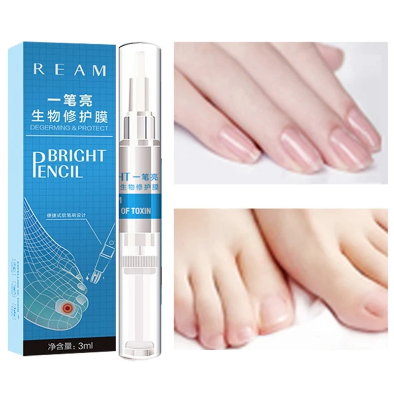 Good Chance of  Feet nail Essence Nail Foot Whitening Toe Nail Fungus Removal Gel Anti Infection Paronychia Onychom