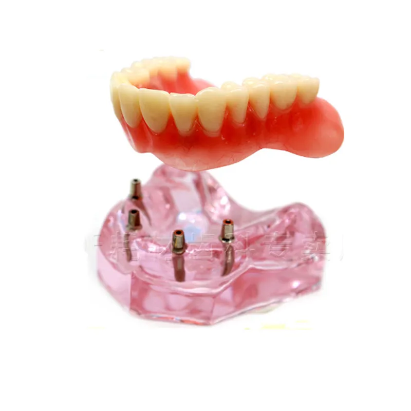 Стоматологический верхний протез Улучшенный 4 имплантаты демонстрационная модель 6001 02 модель зубов