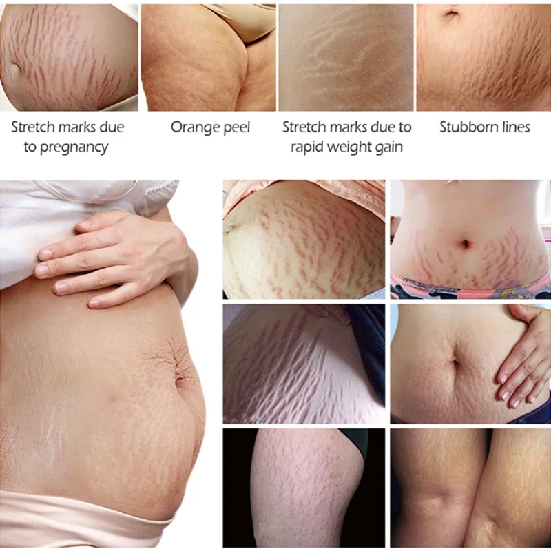 Удаление растяжек ремонт крем для беременных ремонт кожи шрамы ожирение линий кожи Твердый Гладкий уход за кожей