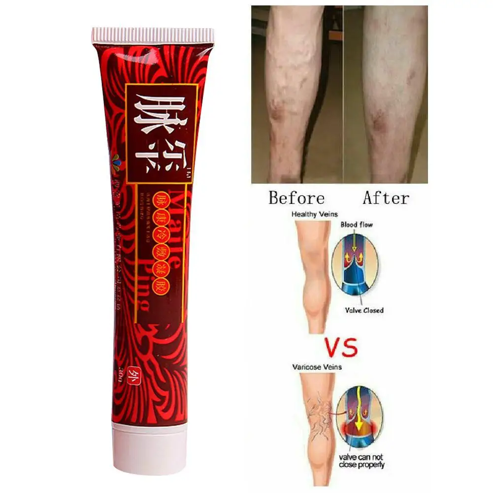 

Varicose Veins Treatment Cream Effective Vasculitis Phlebitis Spider Veins Varicosity Angiitis Treatment Ointment Herbal Cream