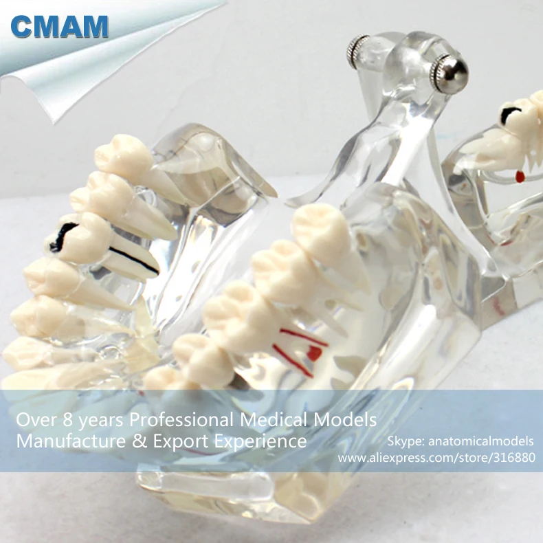 CMAM/12594 Dental-патологическая Стоматологическая модель, 2X в натуральную величину, полости рта человека стоматологический медицинский анатомическая модель