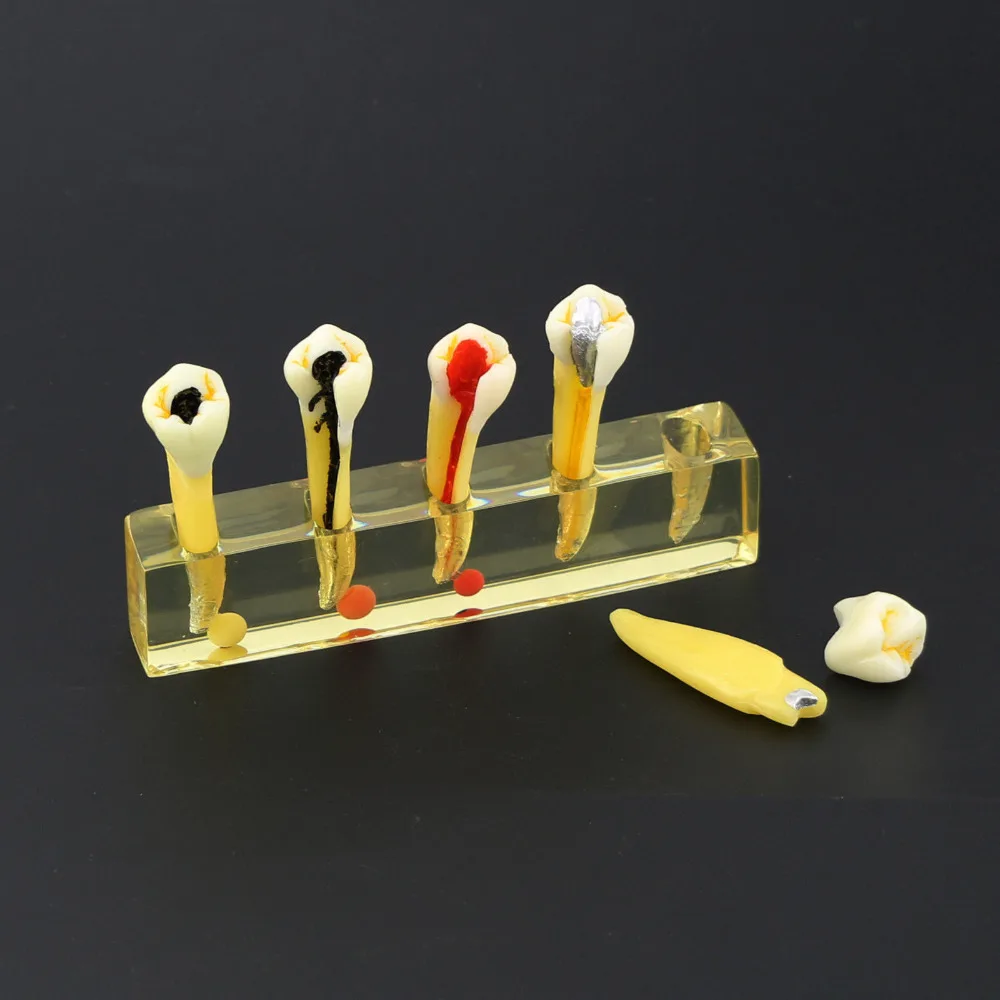 Зубные 5 этап корневого канала эндодонтического лечения Модель Стоматологическая Исследование Научите зубы модель