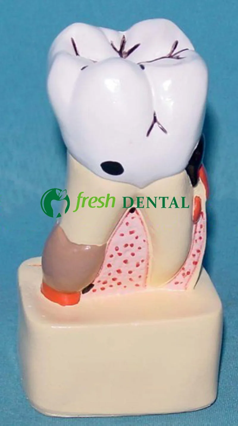 1 шт. зубной анатомический профиль Модель кариеса модель полный патологии модели стоматологических заболеваний SL720